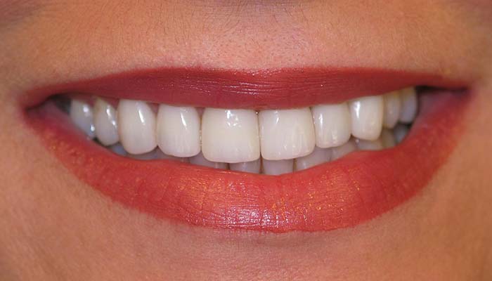 Why Should I Get Nite White or ZOOM Teeth Whitening