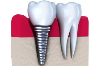 Dental Implants Restore Your Smile