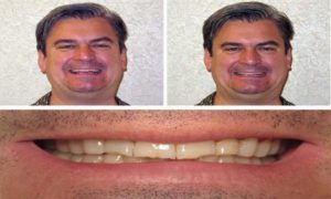 Teeth Grinding, Clenching, and Bruxism Treatment