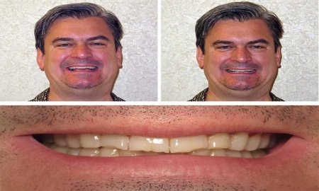 Teeth Grinding, Clenching, and Bruxism Treatment