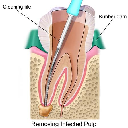 root canal procedures in Plymouth, MN