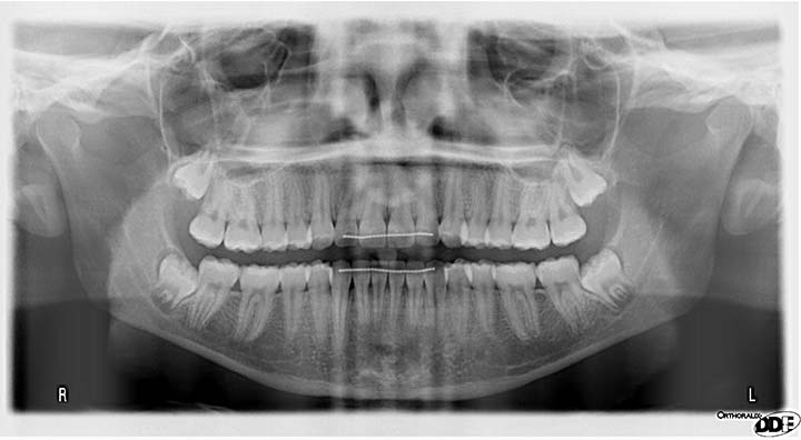 Wisdom Tooth Extraction at Smile Design Dentistry in Plymouth, MN
