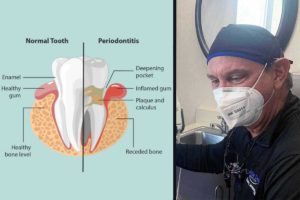 What is Periodontal disease? Do I have periodontitis?