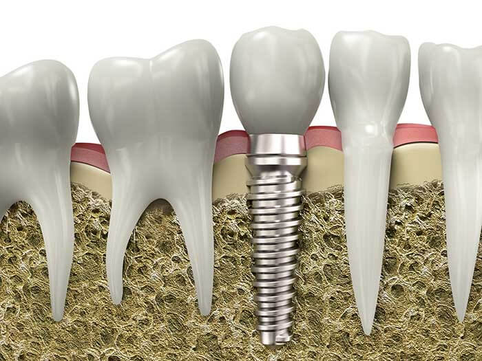 Modern Dental Implant Treatment for the whole family?