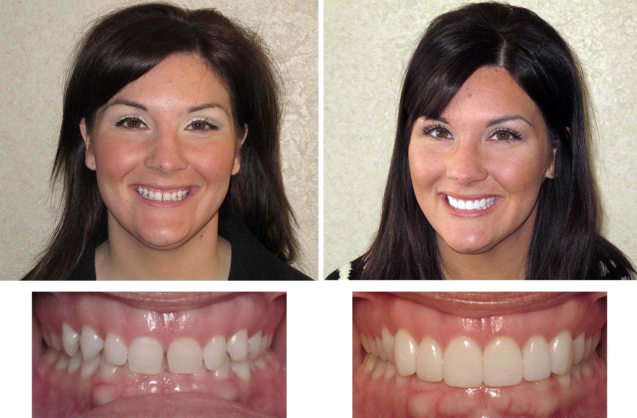 Invisalign, Whitening and Veneers Invisalign, Whitening and Veneers