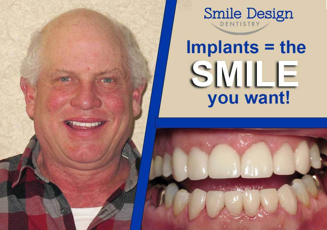What is the Cost of a Dental Implant? 
