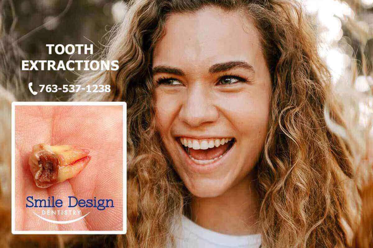 Tooth Extraction Teeth Removal Answers | Plymouth, MN