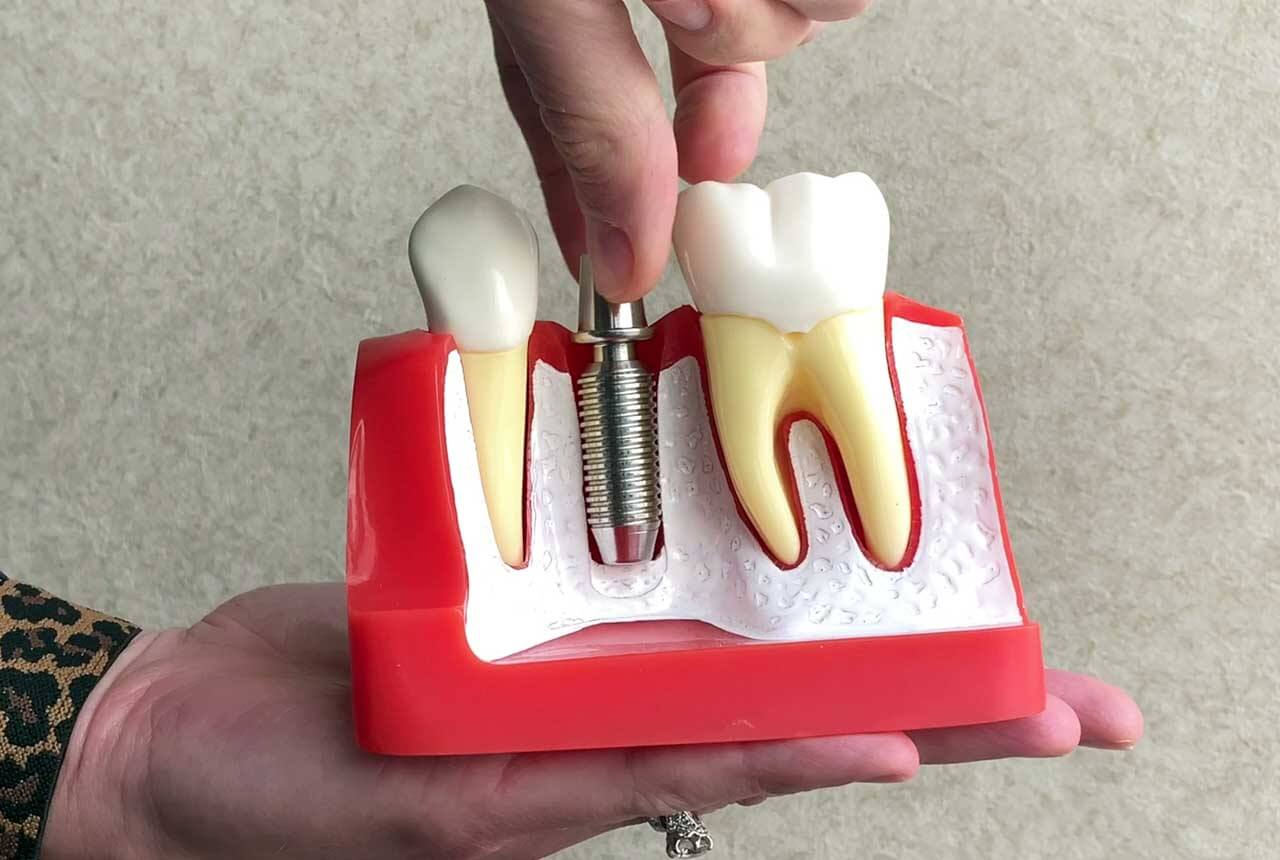 How to Fix a Loose Dental Implant