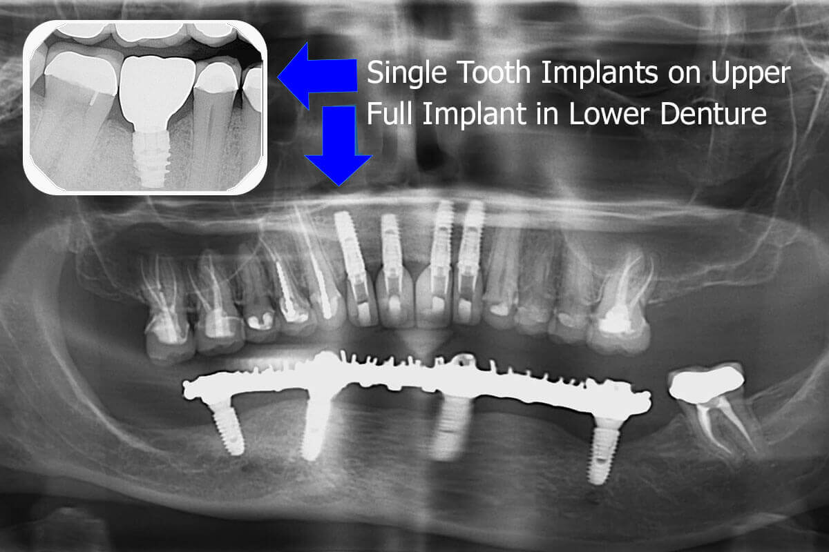 How is my Dental Crown Attached to the Implant?