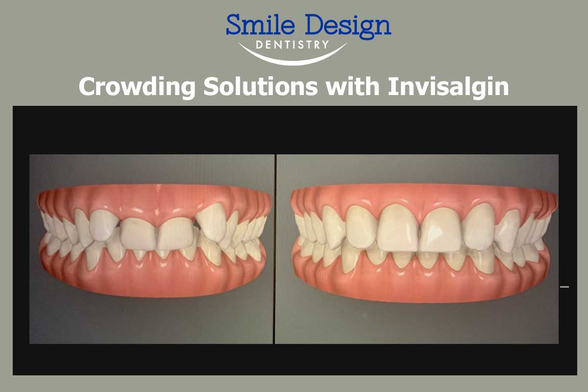 How to Fix Crowded Teeth with Invisalgin Treatment