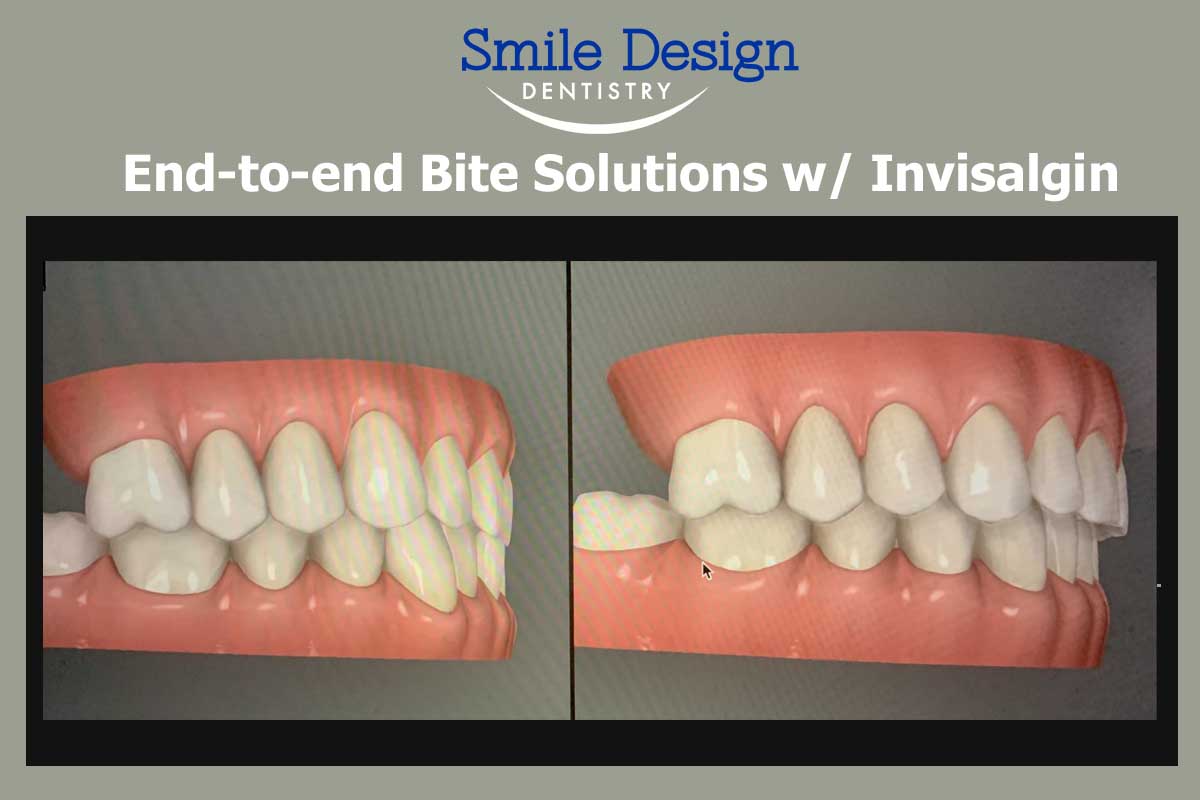 Fixing An End-to-end bite at Smile Design Dentistry in Plymouth, MN