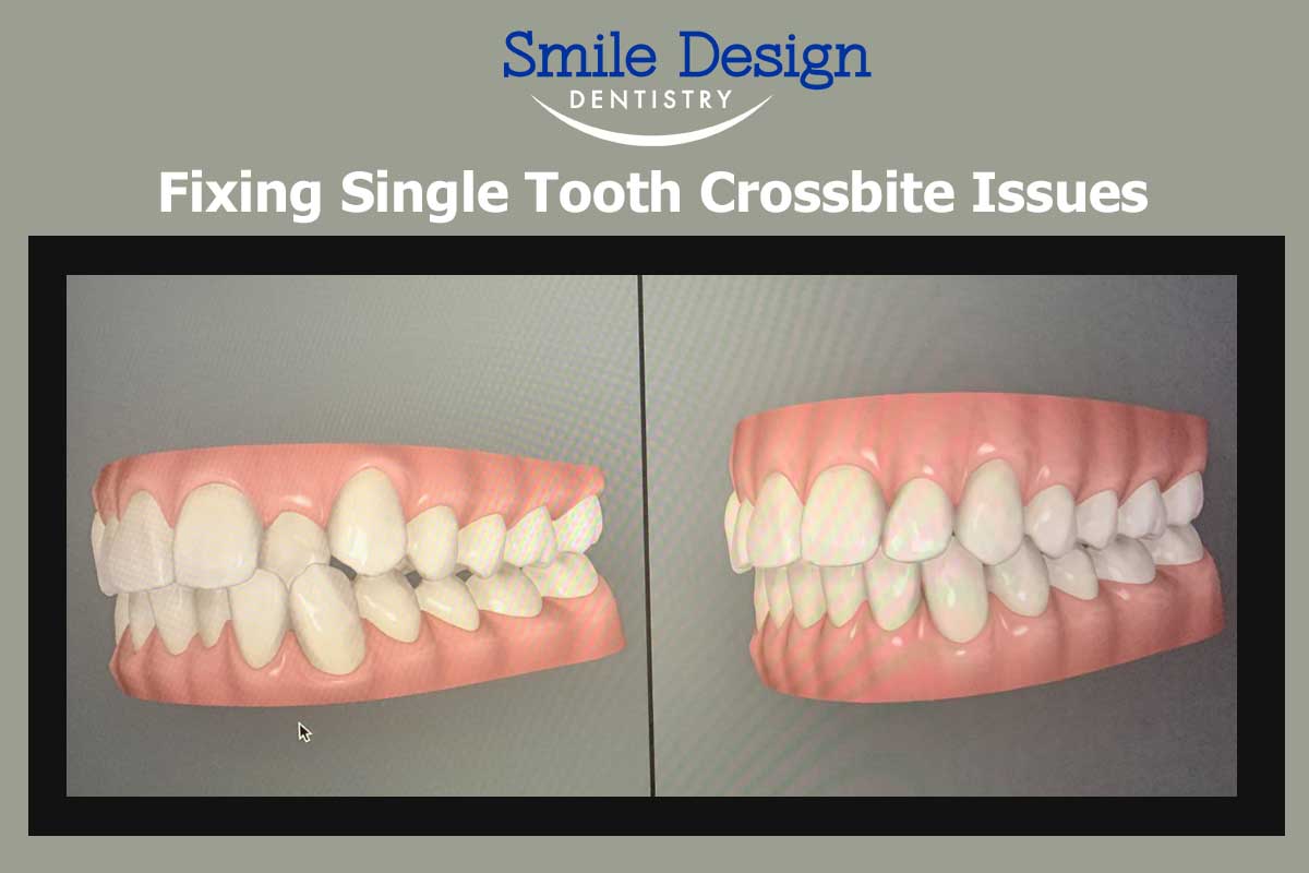 Fixing A Single tooth crossbite