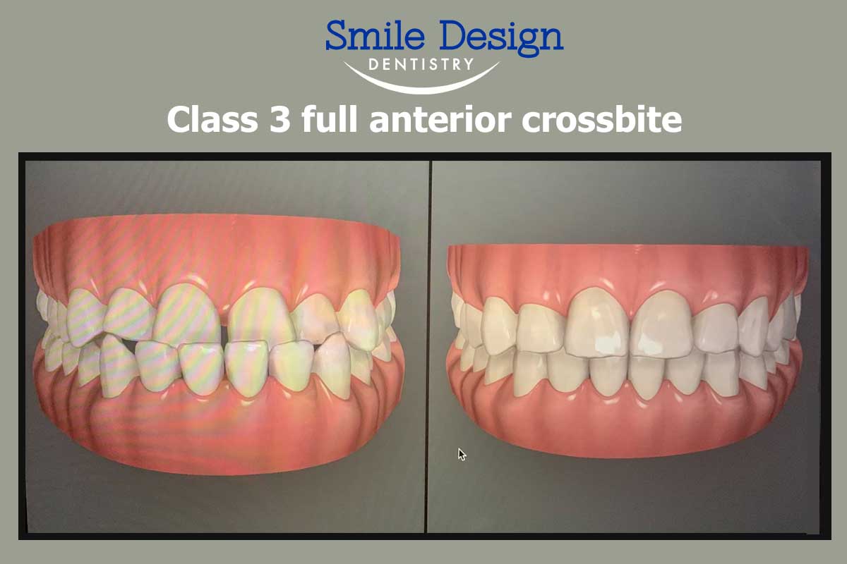 Fixing A Class 3 full anterior crossbite at Smile Design Dentistry in Plymouth, MN