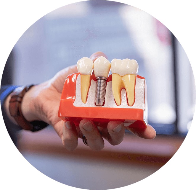 dental implant model