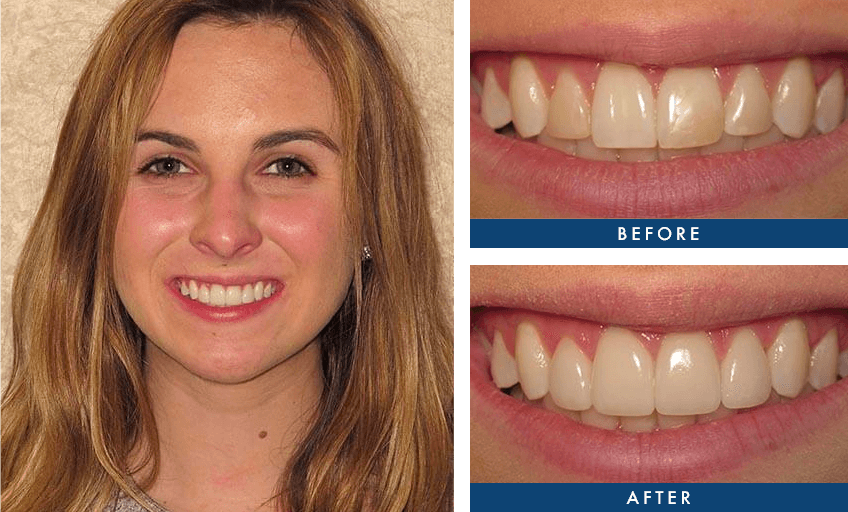 dental before and after