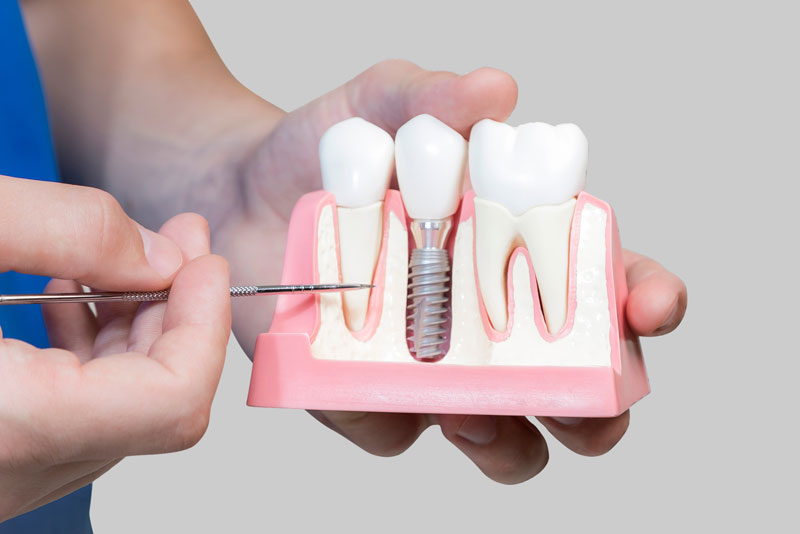 Dental Assistant Showing Off A Dental Implant In A Jawbone Cutaway Model in Plymouth, MN