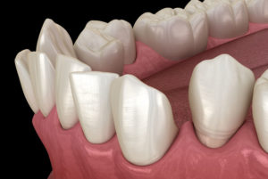 a model of a lower arch of crooked teeth in need of Invisalign clear aligners.