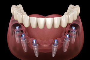 a full mouth dental implant model against a black background that shows how they are placed in a full mouth dental implant procedure.
