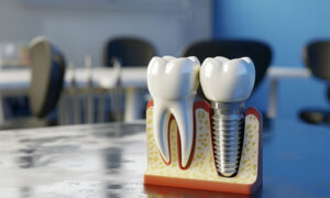 Dental implant model on a reflective table, dental office in the background.